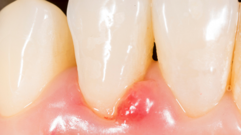 Problemas com Gengivite ou Periodontite? A Periodontia esclarece.