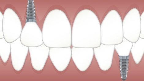 Implantes dentários, a melhor opção para quem perdeu um ou mais dentes.