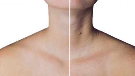 Botox no pescoço? Dra Paula Ahmed explica como funciona e quais as finalidades do procedimento