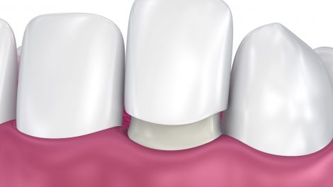 O que você precisa saber sobre facetas de porcelana e lentes de contato?