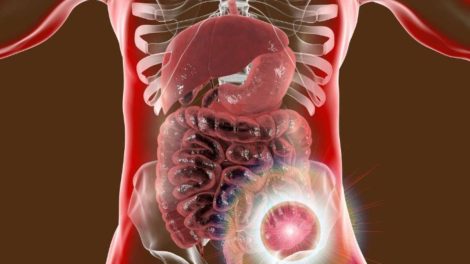 O câncer do intestino pode ser silencioso, a prevenção é importante