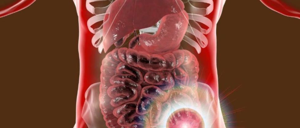 O câncer do intestino pode ser silencioso, a prevenção é importante